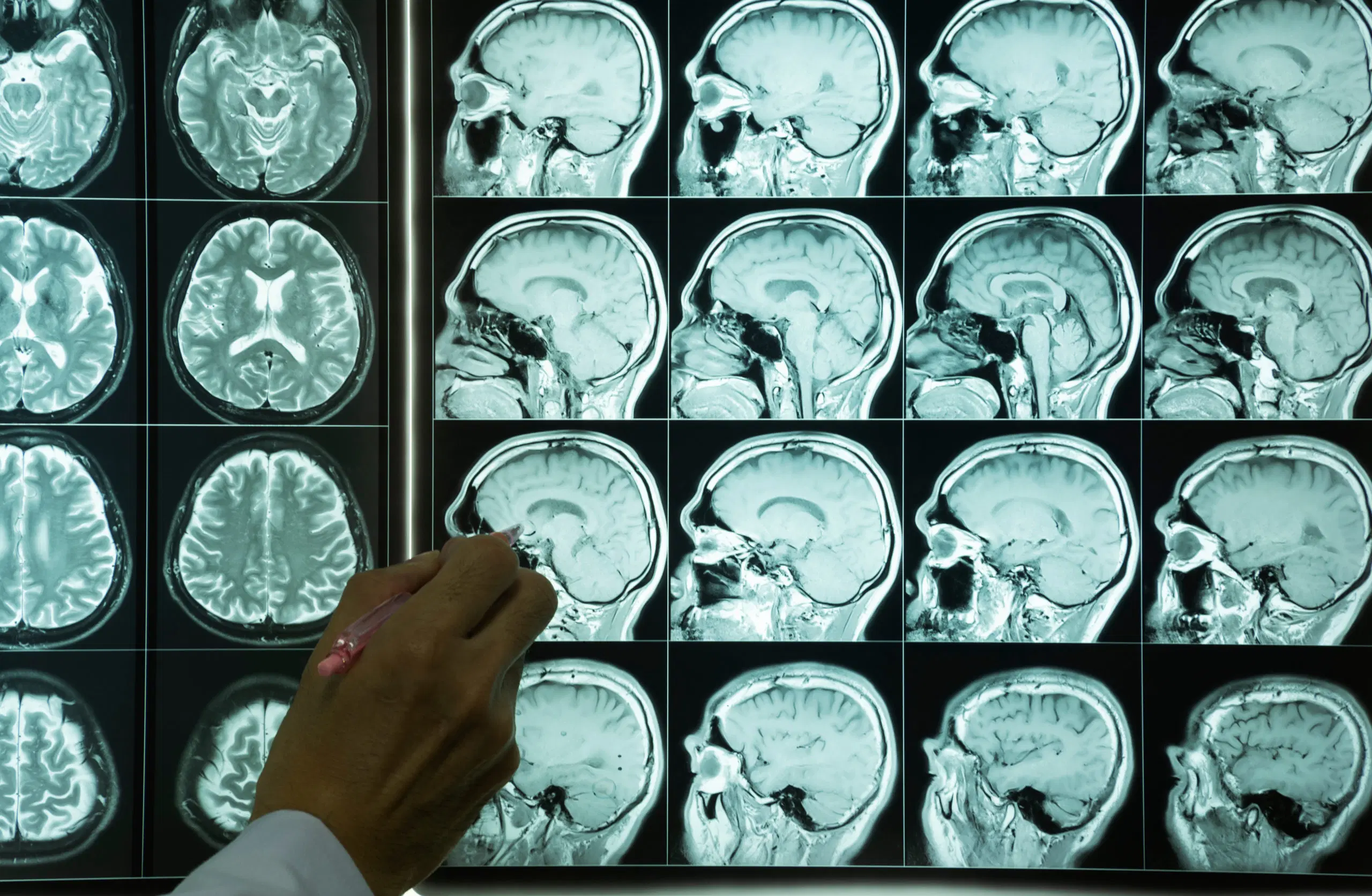 Neurological diseases surge in Guyana, Caribbean nations